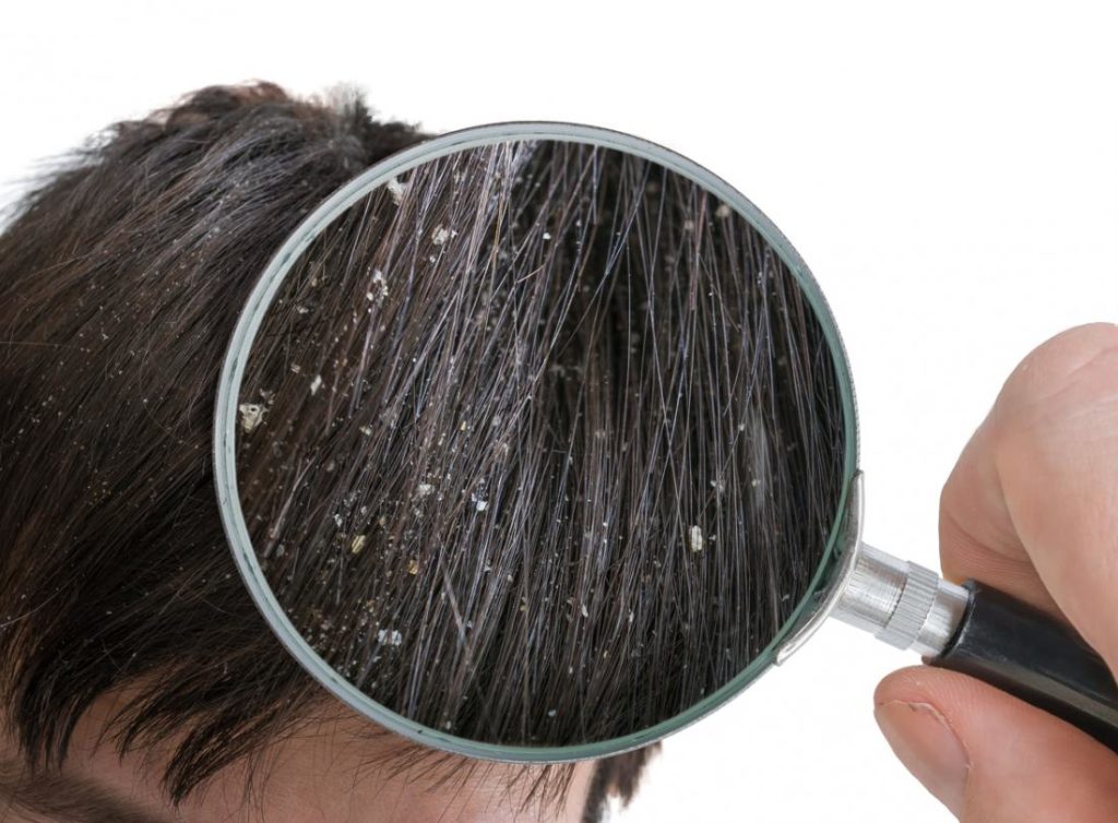 How To Treat Dandruff Dry Scalp Graph My Health